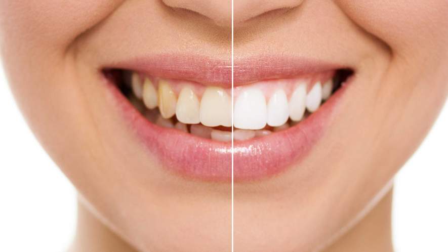 Bleaching - weißere Zähne in einer Behandlung