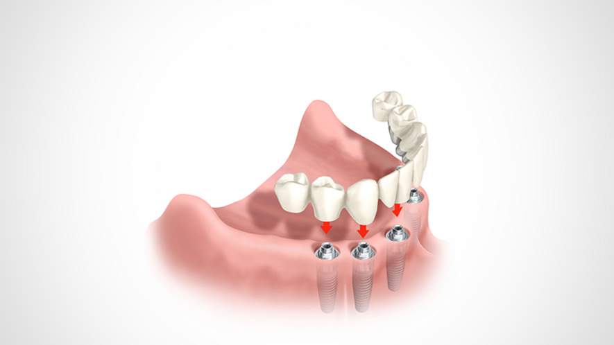 Implantate bei zahnlosem Kiefer