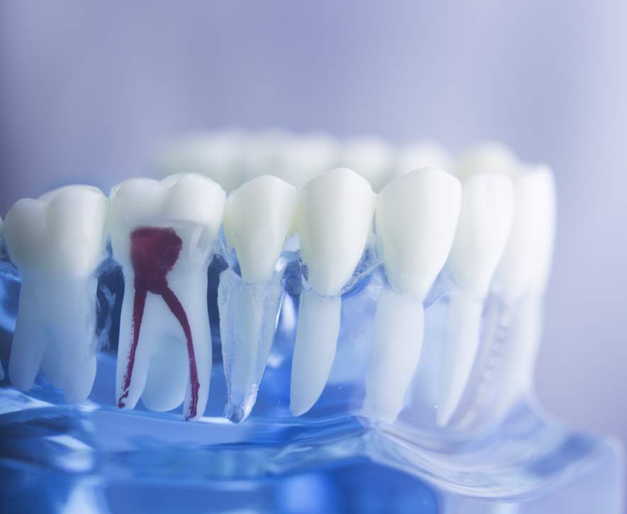 Zahnwurzelbehandlung nicht schmerzhafter als andere Behandlungen