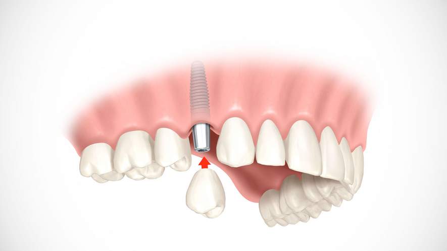 Zahnersatz auf Implantaten