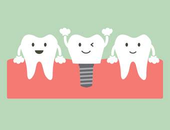 Wie lange halten Zahnimplantate?