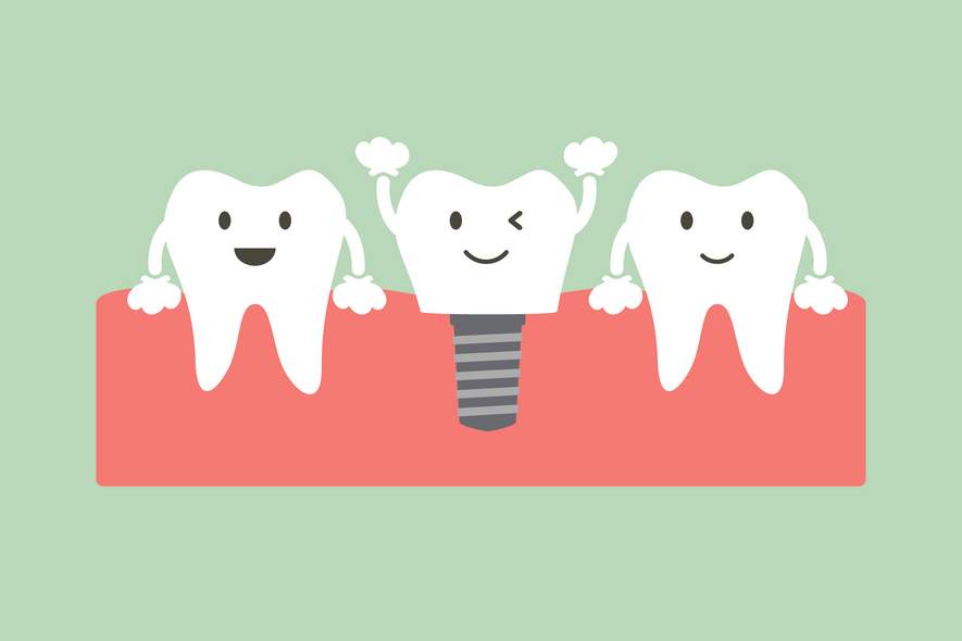 Wie lange halten Zahnimplantate?