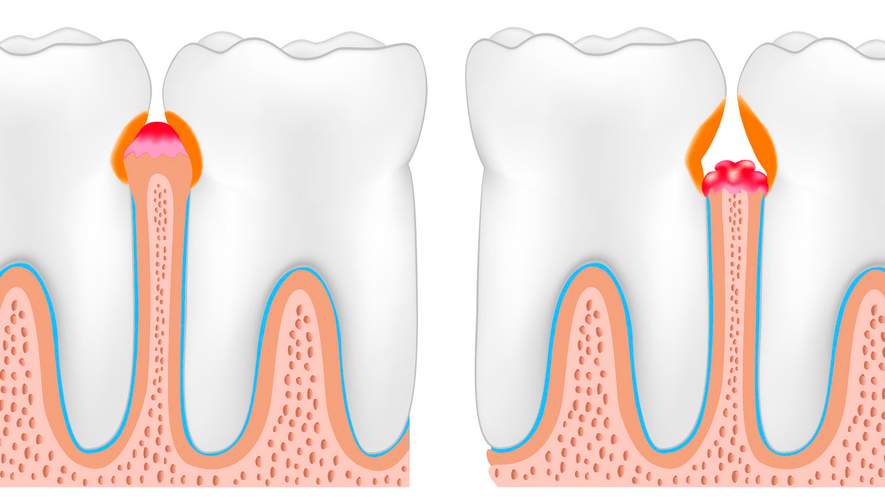 Новые сведения о возникновении пародонтита