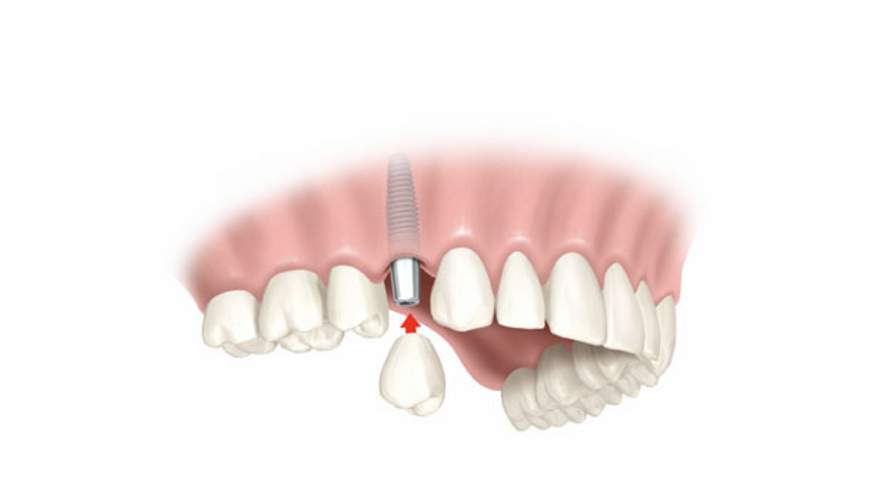 Schliessen von Schaltlücken mit Implantaten