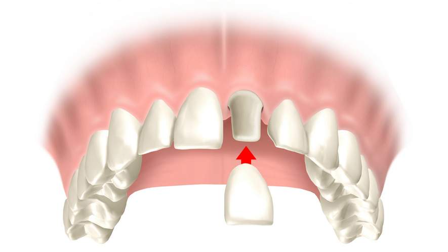 Протезирование одного зуба с опорой на имплантат