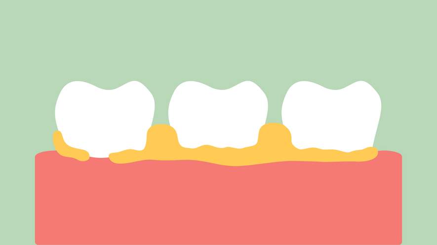 Biofilm – Die bakterielle Besiedlung der Zahnoberfläche