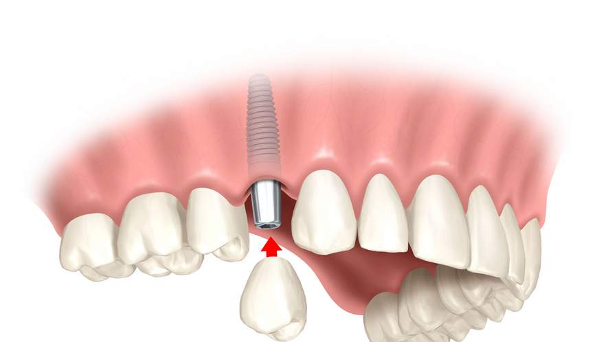 Implantatbehandlungen bei verschiedenen Zahnsituationen