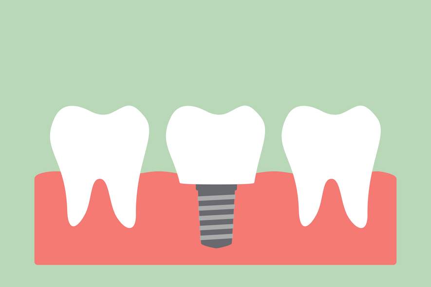 Zahnfleisch: Sieht man nach der Implantation Narben?
