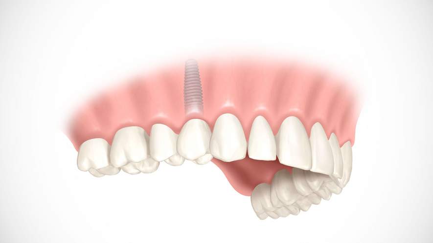 Zahnimplantate - neue, feste Zähne bei Zahnverlust
