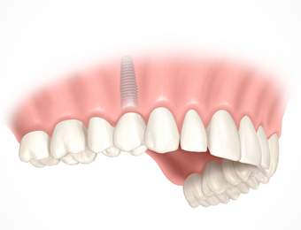 Vorteile minimal-invasiver Zahnimplantate