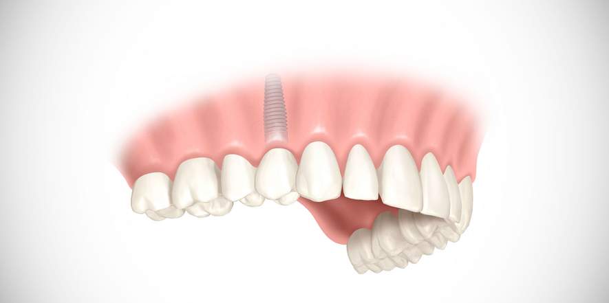 Vorteile minimal-invasiver Zahnimplantate